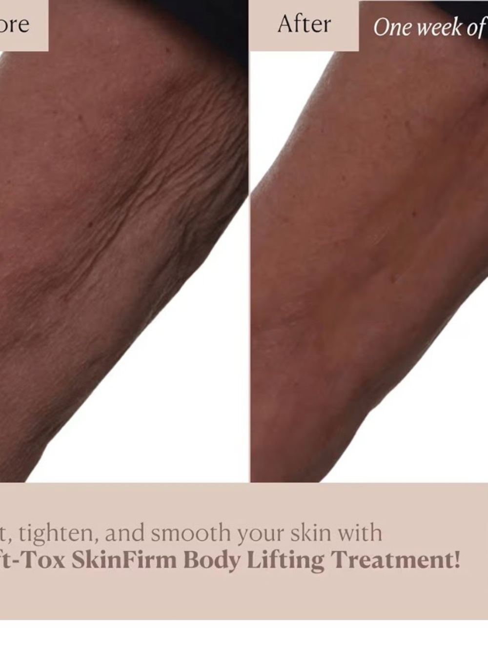 Lift-TOX SkinFirm Body Lifting Treatment — - Picture 2 of 4